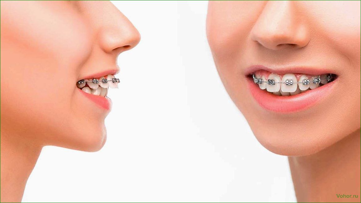 Брекеты на зубы — эффективное решение для идеального улыбки и здоровья полости рта